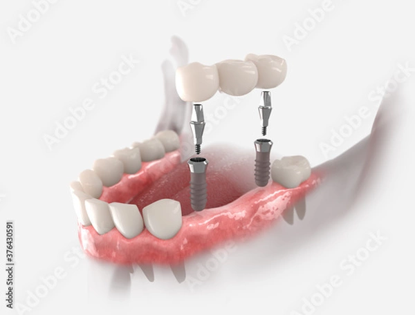 Fototapeta 3d illustration of gums with dental bridge, supported by two implants