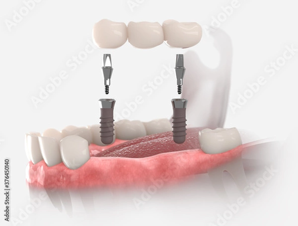 Fototapeta 3d illustration of gums with dental bridge, supported by two implants. 