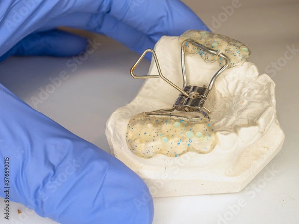 Fototapeta Teeth gypsum model with Hyrax Expander braces