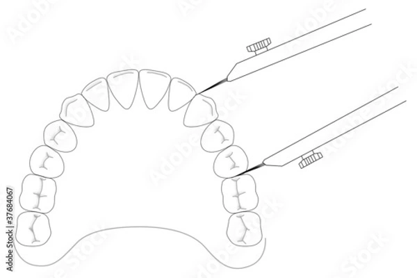 Obraz Korkhaus calipers