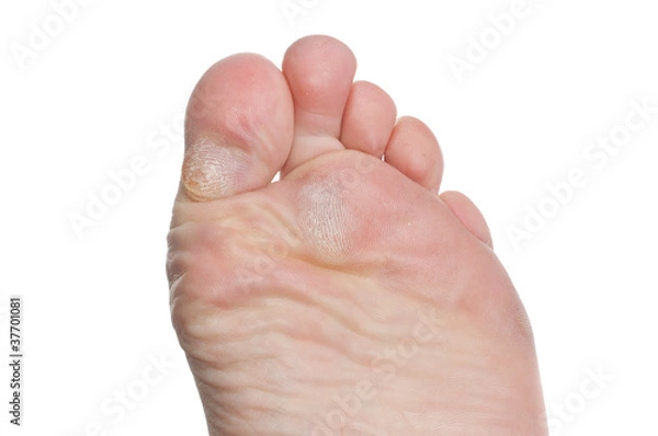 Fototapeta Callus on toes