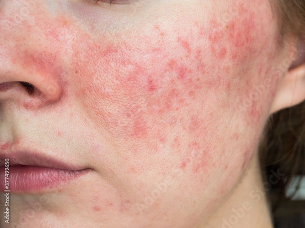 Fototapeta papulopustular rosacea, close-up of the patient's cheek
