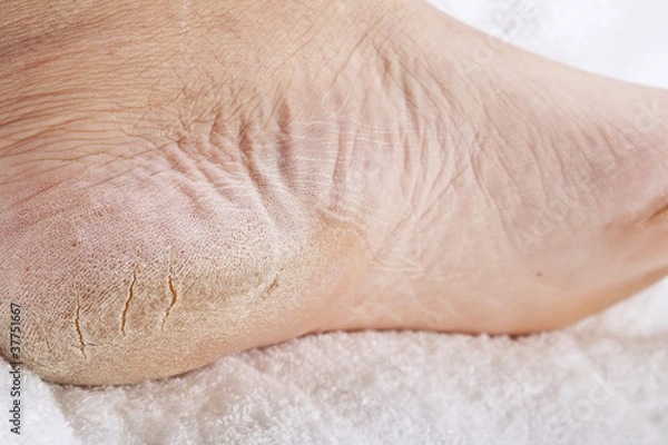 Obraz Stopy wymagające pedicure