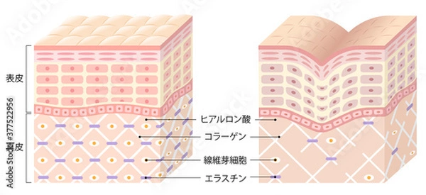 Obraz しわ　肌の断面図　ビフォアアフター