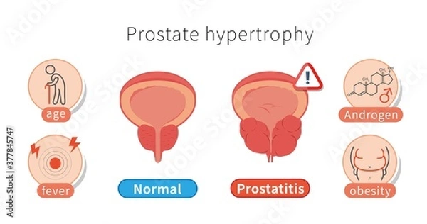 Fototapeta Male healthy and unhealthy prostate, cause of prostate hypertrophy and inflammation isolated on white background