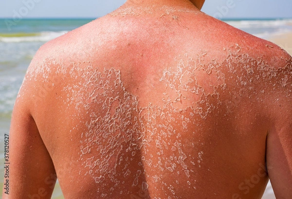 Obraz Dangerous sunburn on the sandy beach. Men with sun damaged peeling skin on the shoulders and back