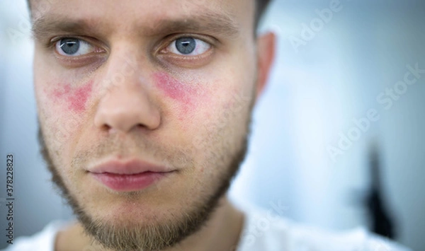 Fototapeta man suffers from systemic lupus erythematosus, age spots of redness on the face, a rash.
