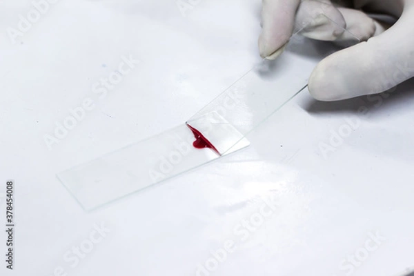 Obraz glass slide smear drawing of blood by glass slide