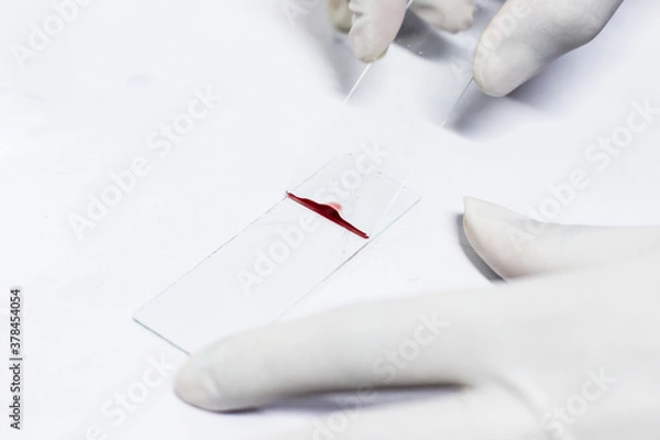 Obraz smear drawing of blood by glass slide