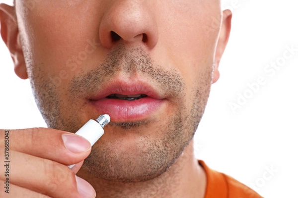 Fototapeta Young man with cold sore applying cream on lips against white background, closeup