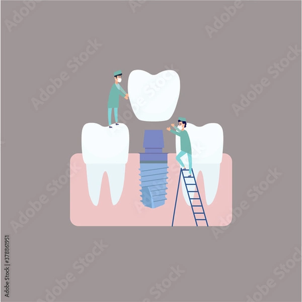 Fototapeta Two dentists perform dental implantation: install the implant on the abutment. Vector illustration, in a flat style. Poster to the clinic, image for instructions for dentists, training books