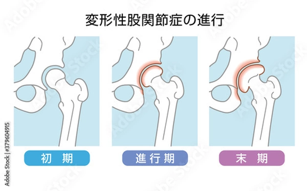 Fototapeta 変形性股関節症の進行