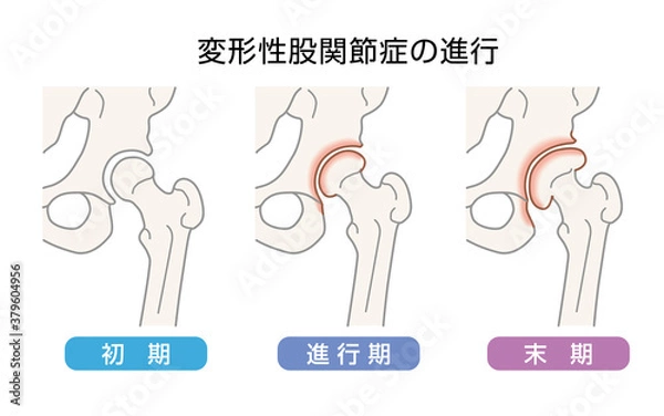 Obraz 変形性股関節症の進行　