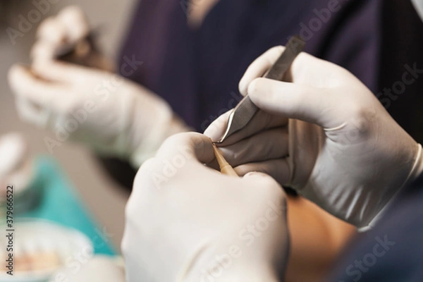 Fototapeta Hair transplantation is a surgical technique that moves hair follicles from a part of the body called