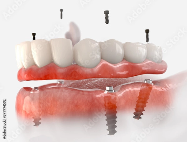 Fototapeta Mandibular fixed restoration with 4 implants.  3d illustration of implant on white background.