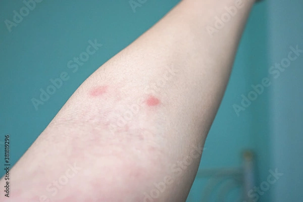 Obraz two red rash on the arm skin
