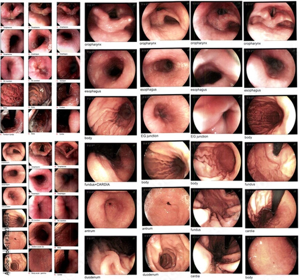 Obraz Collection Gastrointestinal endoscopic examination image showing acute on chronic gastritis.Medical healthcare concept.Soft and blurry when views full solution.