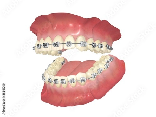 Obraz 歯列矯正