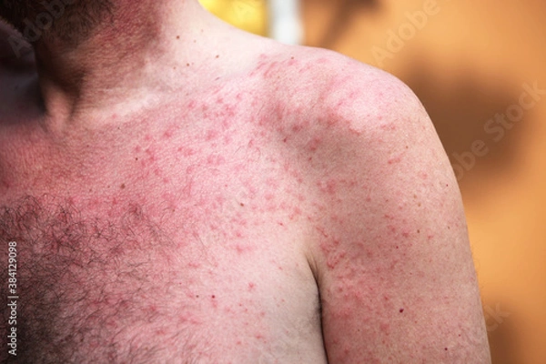 Fototapeta Rash or sun allergy