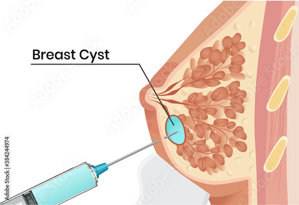 Obraz Breast cyst aspiration under the ultrasound guidence