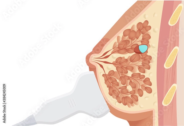 Obraz Ultrasound of the simple cyst of the breast vector illustration