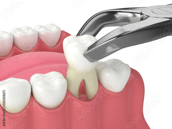 Fototapeta 3d render of lower jaw with tooth extraction