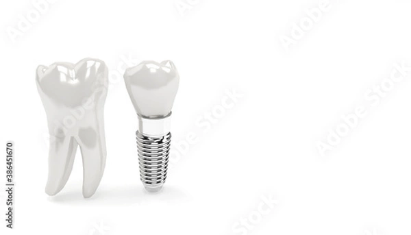 Fototapeta Tooth or Dental implant, human denture close-up 3d illustration. Teeth root embed in jaw bone to support artificial crown. Anatomy concept isolated on  background with copy space.  