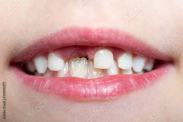 Fototapeta  the child shows the first lost tooth