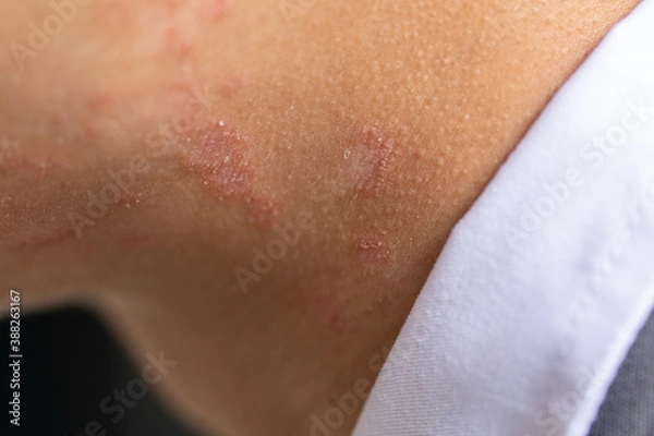 Obraz Tinea circinata or ringworm on the head.
