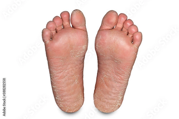 Obraz Problemy skóry stóp, suche obcasy na białym tle