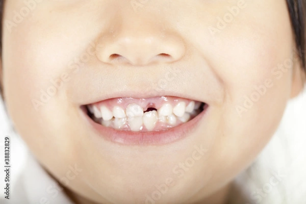 Fototapeta 歯がない女の子