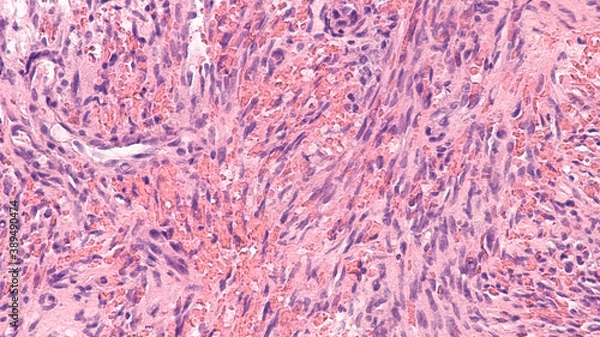Fototapeta Kaposi's sarcoma is a type of cancer of blood vessels caused by a virus, herpesvirus 8 (HHV-8), affecting skin and mouth, sometimes internal organs.  Associated with immunosuppression from HIV, AIDS. 