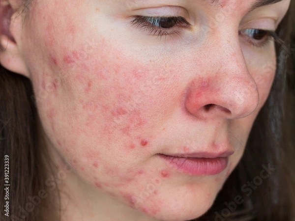 Obraz papulopustular rosacea, close-up of the patient's cheek