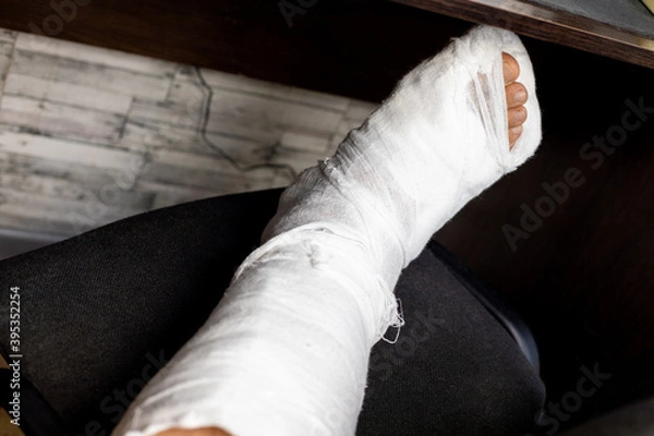 Fototapeta Leg in bandage fixed after bone broken.