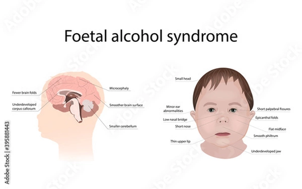 Obraz Illustration showing the effects of foetal alcohol syndrome on the brain and on a child's face. With explanations.