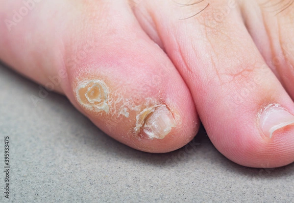 Obraz Large dry callus on the little toe of a man's foot. Consequences of wearing uncomfortable, tight shoes.