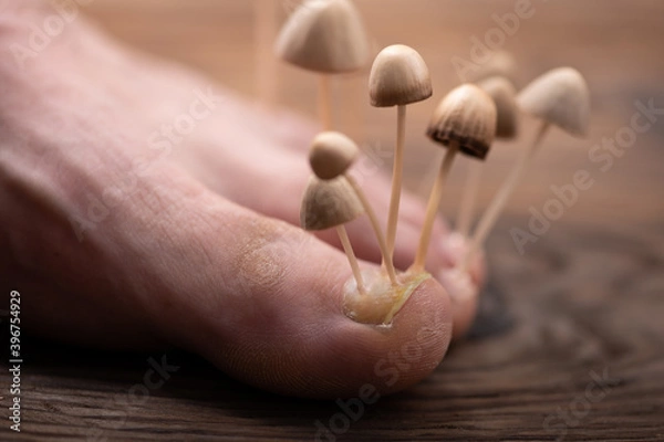 Fototapeta Fungi grow from the nail plates on the foot. Concept of nail fungus, skin and nail infections. Foot with fungus close-up in the background light.