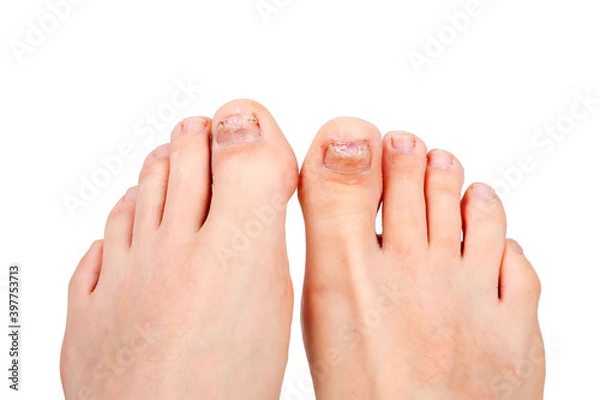Fototapeta toenails affected by fungus, isolate, white background