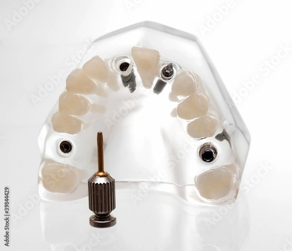Obraz dental implants3
