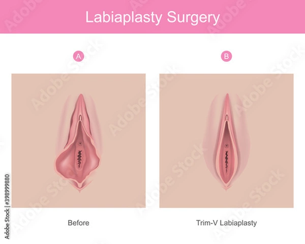 Obraz labiaplasty surgery. Illustration for medical use explain a procedure surgery to decrease the size of inner tissues the female genitalia..