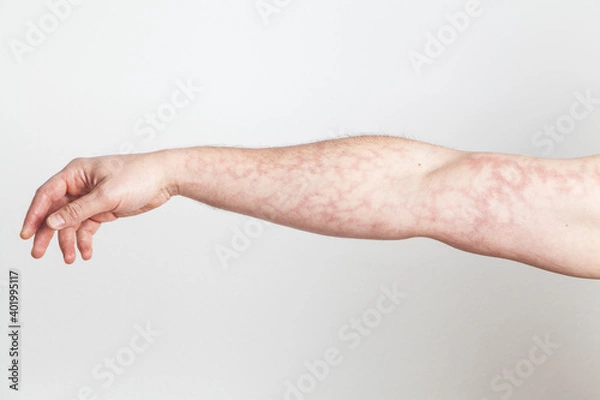 Obraz Male upright arm with red skin capillary network