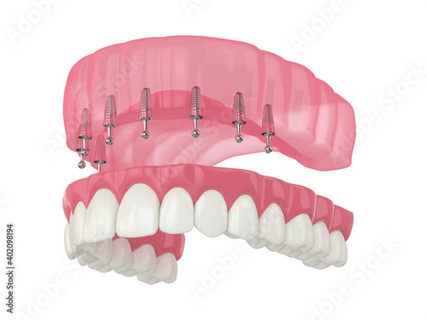 Fototapeta 3d render of removable snap-on full implant denture installation