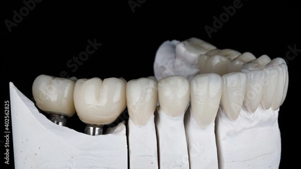 Fototapeta dental model with ceramic crowns and white veneers on a black background