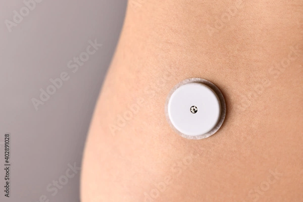Fototapeta Glucose monitoring sensor system attached to skin of person with diabetes illness used to permanently keep track of blood sugar level