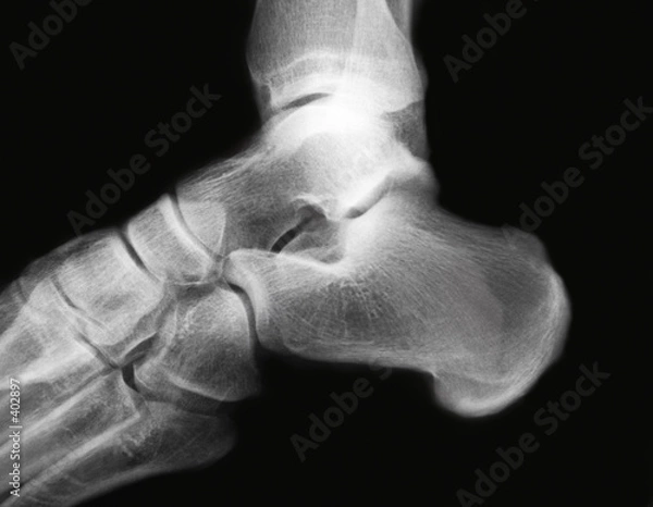 Fototapeta ankle x-ray