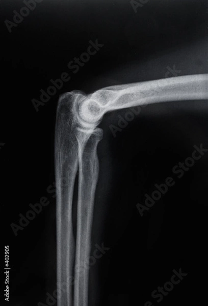 Fototapeta knee bones