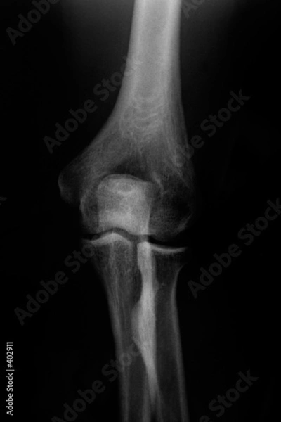 Fototapeta knee bones