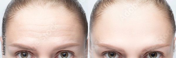 Obraz Forehead wrinkles before and after injection, treatment, surgery. Womans face close up