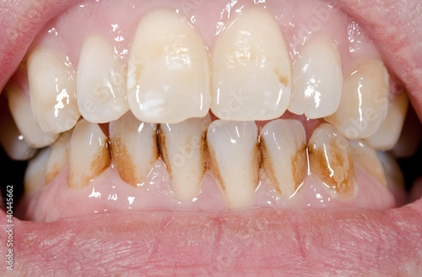 Obraz Zahnfront mit Belägen