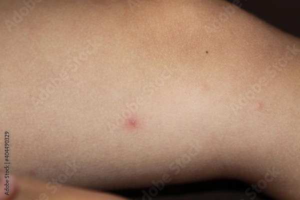 Fototapeta chicken pox varicella disease